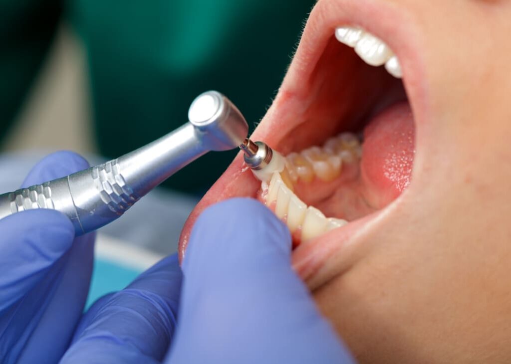 Dental Cleaning done by a professional dental hygienist