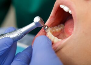 Dental Blog - Horizons Dental Care | Dentist in Ottawa - Dental Cleaning done by a professional dental hygienist