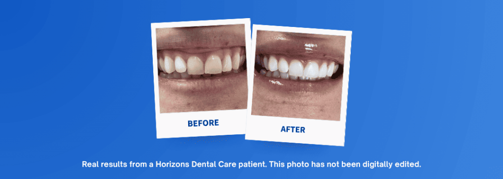 Horizons Dental Care | Dentist in Ottawa - teeth whitening with zoom