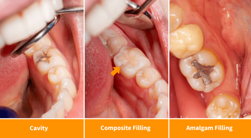 dental fillings compared dental fillings compared
