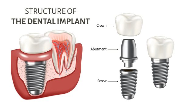 dental implant explained dental implant explained