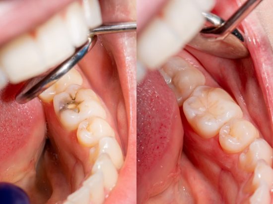 Composite Fillings Composite Fillings