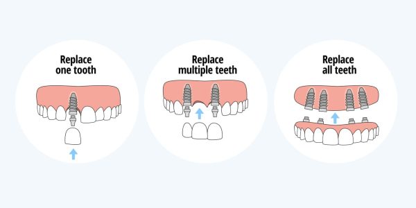range of dental implants range of dental implants