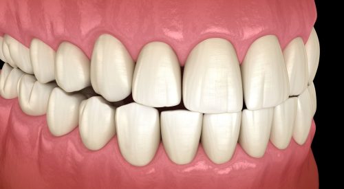 occlusal disease occlusal disease