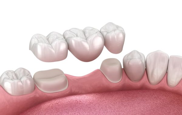 dental bridge dental bridge