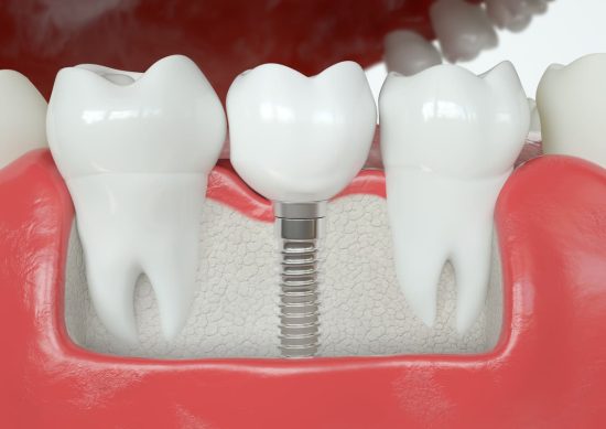3d representation of dental implant